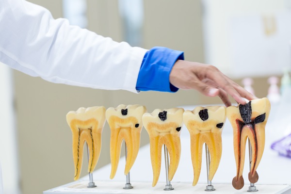 The Number Of Visits Needed For A Root Canal Treatment